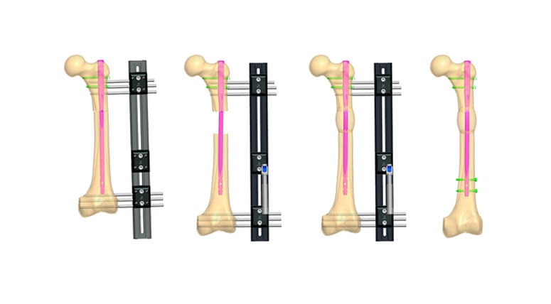 diferencias fijador min